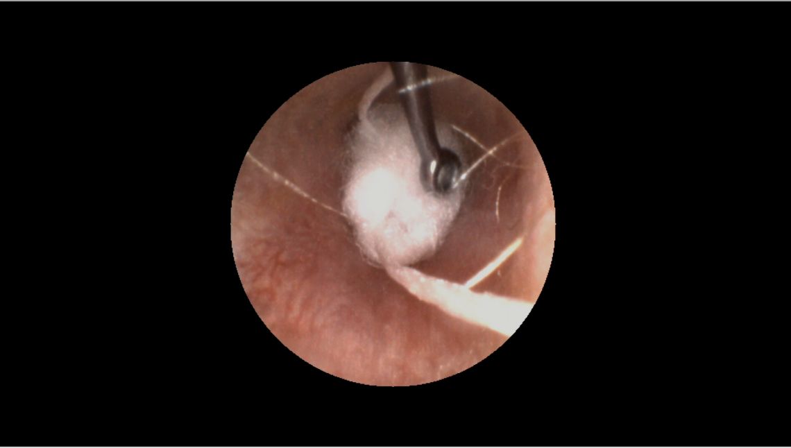 A video Otoscope view of the man placing an otoblock in an ear.